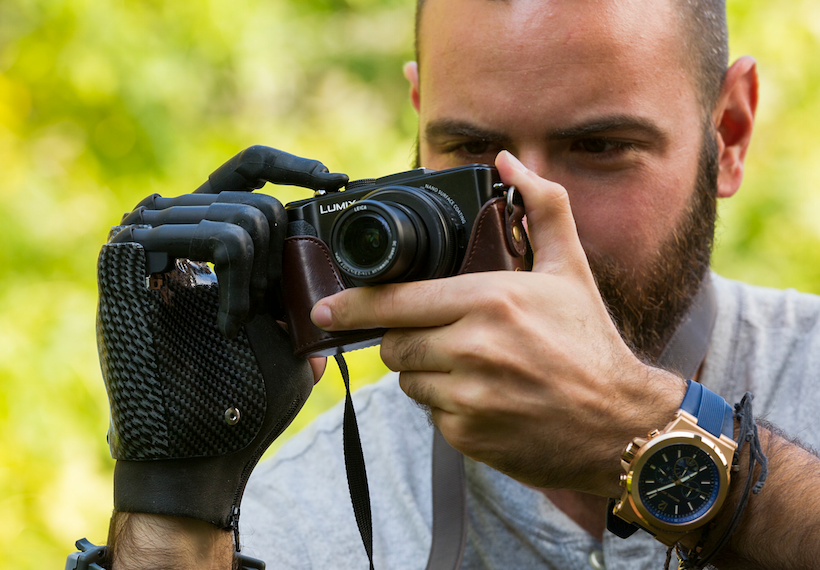 Ο πρώτος άνθρωπος στην Κύπρο με βιονικό χέρι: Εκατοντάδες με προσθετικά μέλη – 70% των νέων περιστατικών είναι διαβητικοί