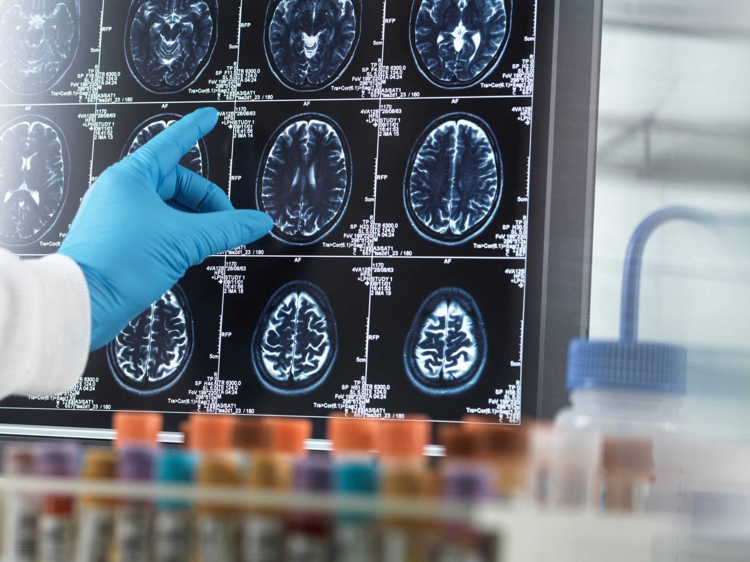 Ο καρκίνος μπορεί να προστατεύει από τη νόσο Αλτσχάιμερ – Τι δείχνει μια νέα επιστημονική μελέτη